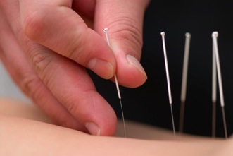 Acupuncture needles