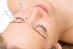 acupuncture for sinusitis