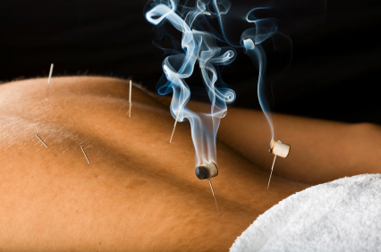 acupuncture for back pain