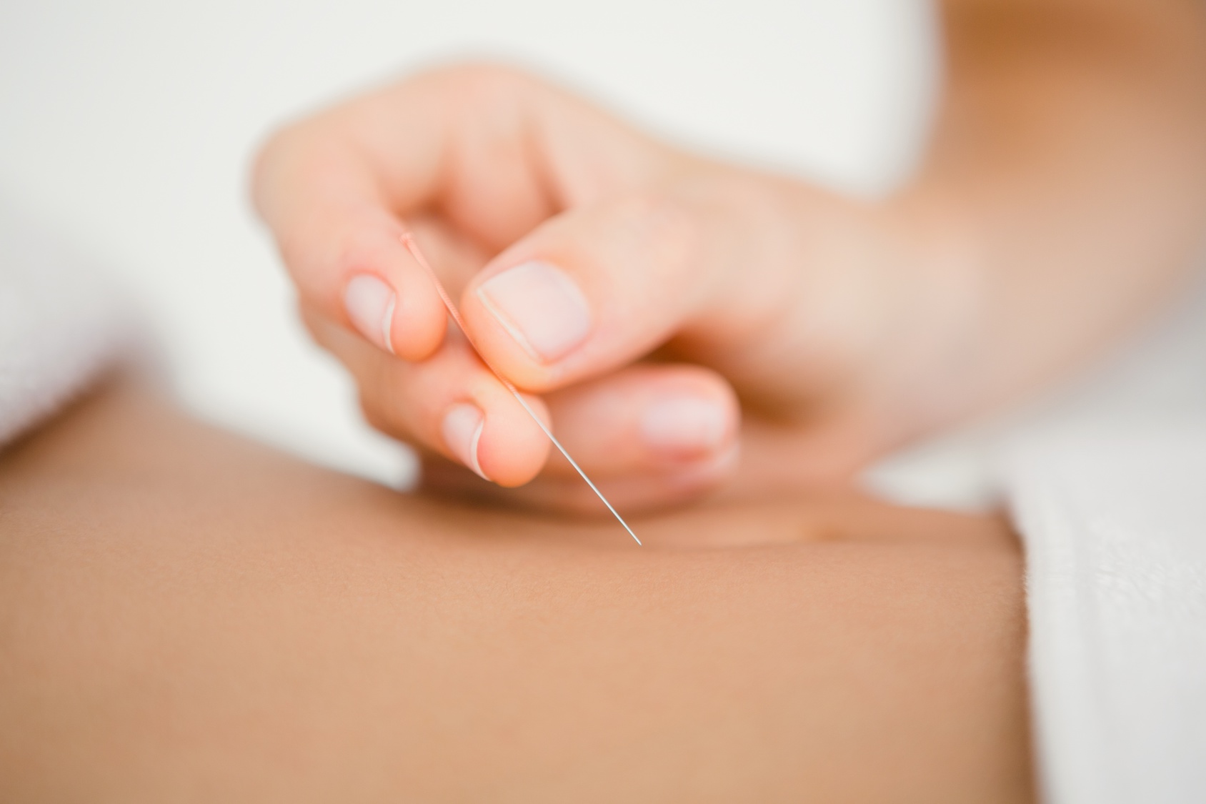 history of acupuncture