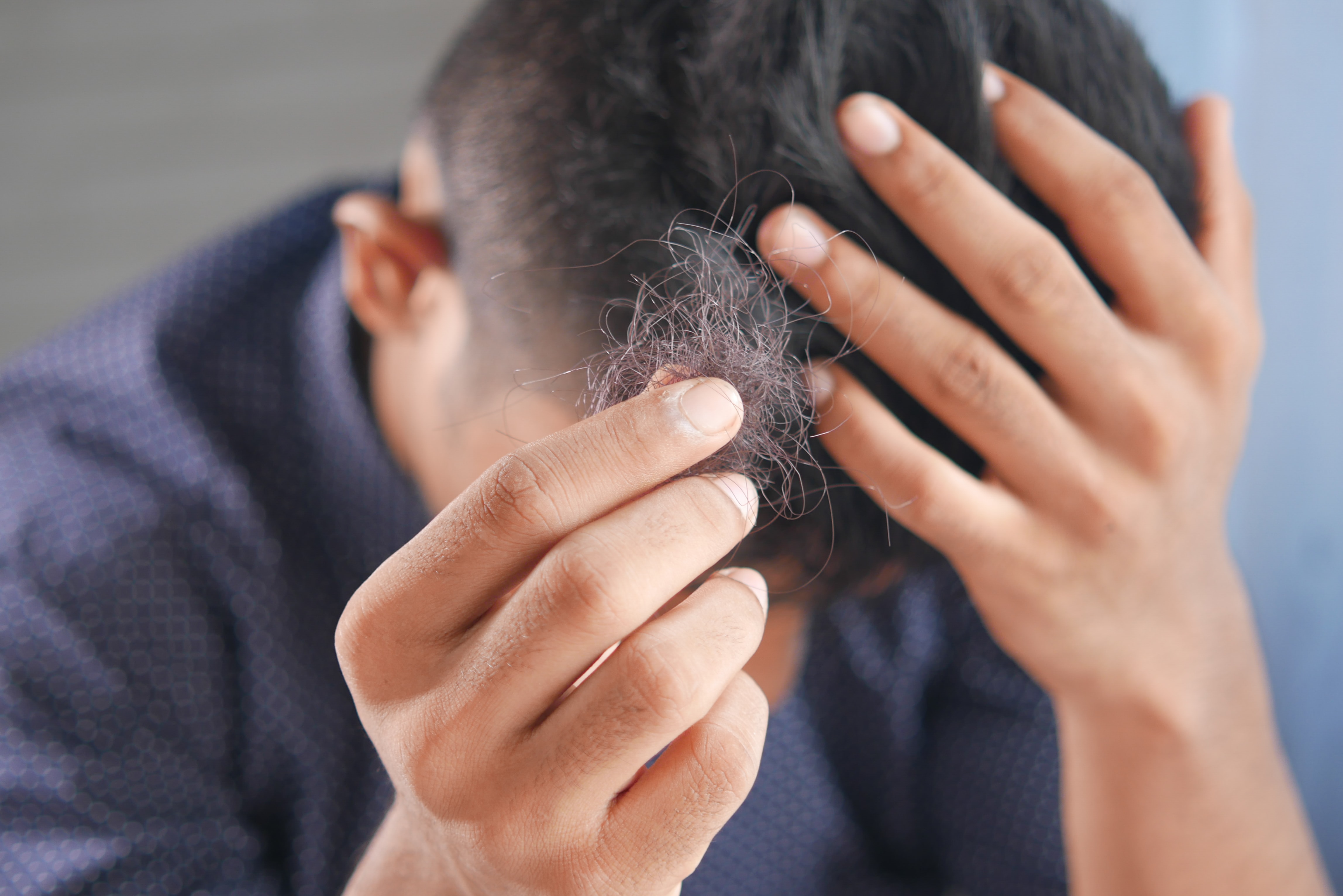 What Hormones Cause Hair Loss?